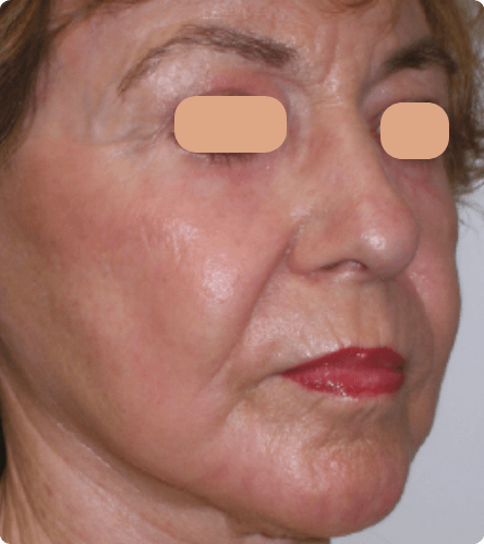 After treatment